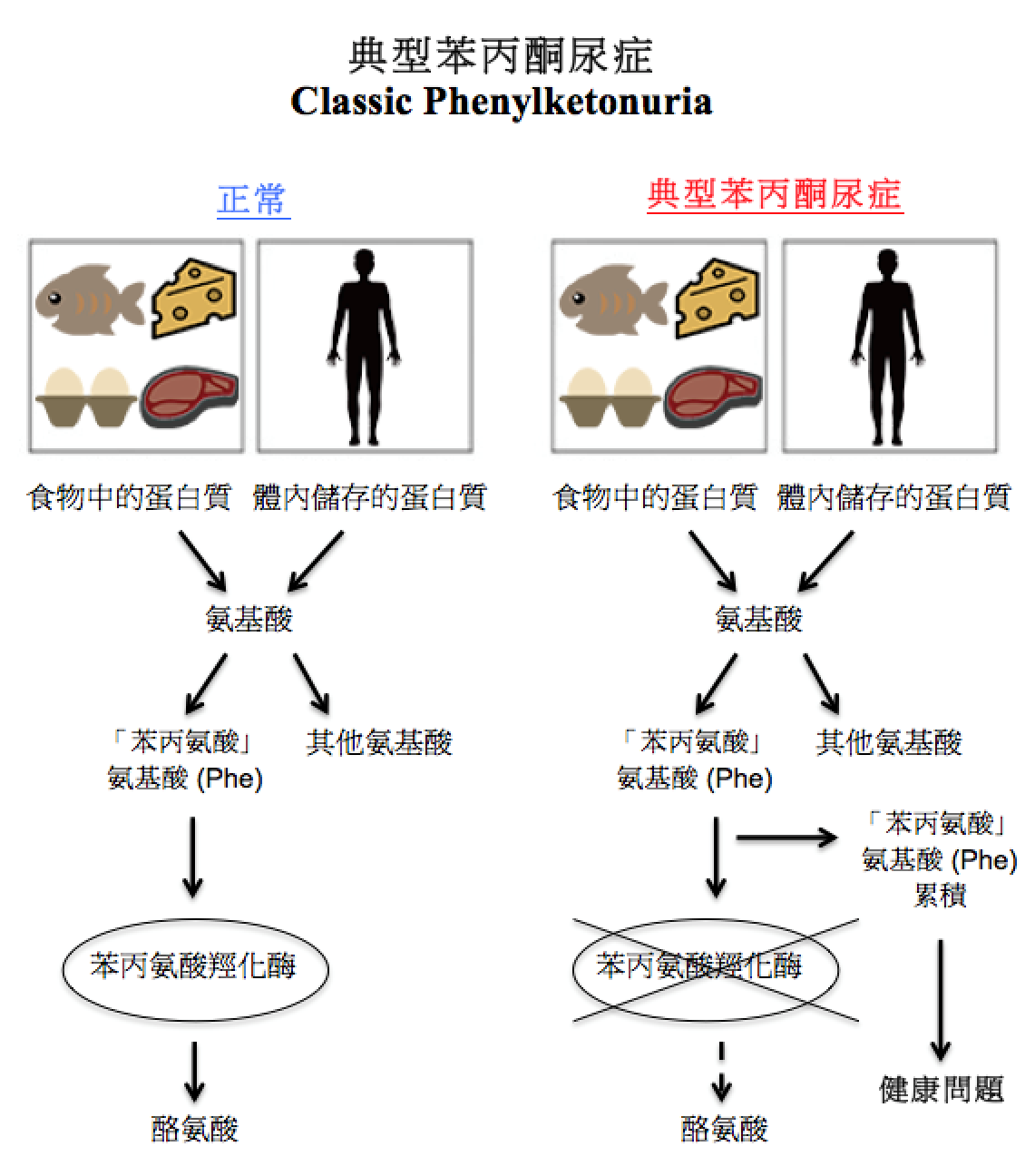 典型苯丙酮尿症圖解