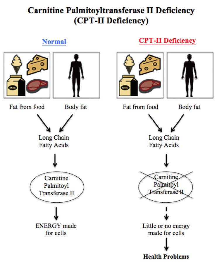Carnitine palmitoyltransferase II deficiency diagram