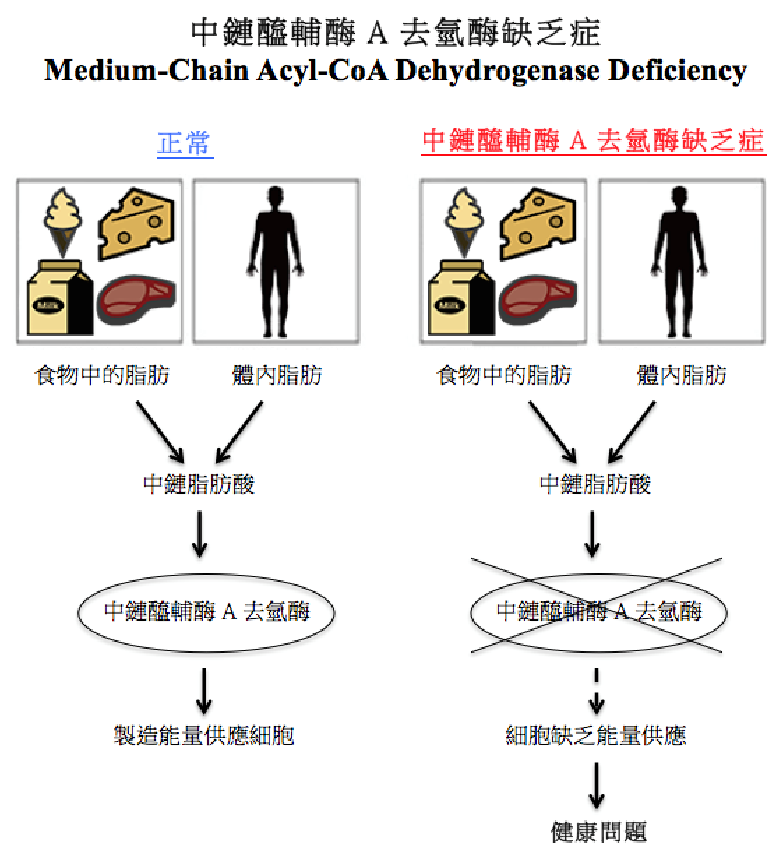中鏈醯輔酶A去氫酶缺乏症圖解